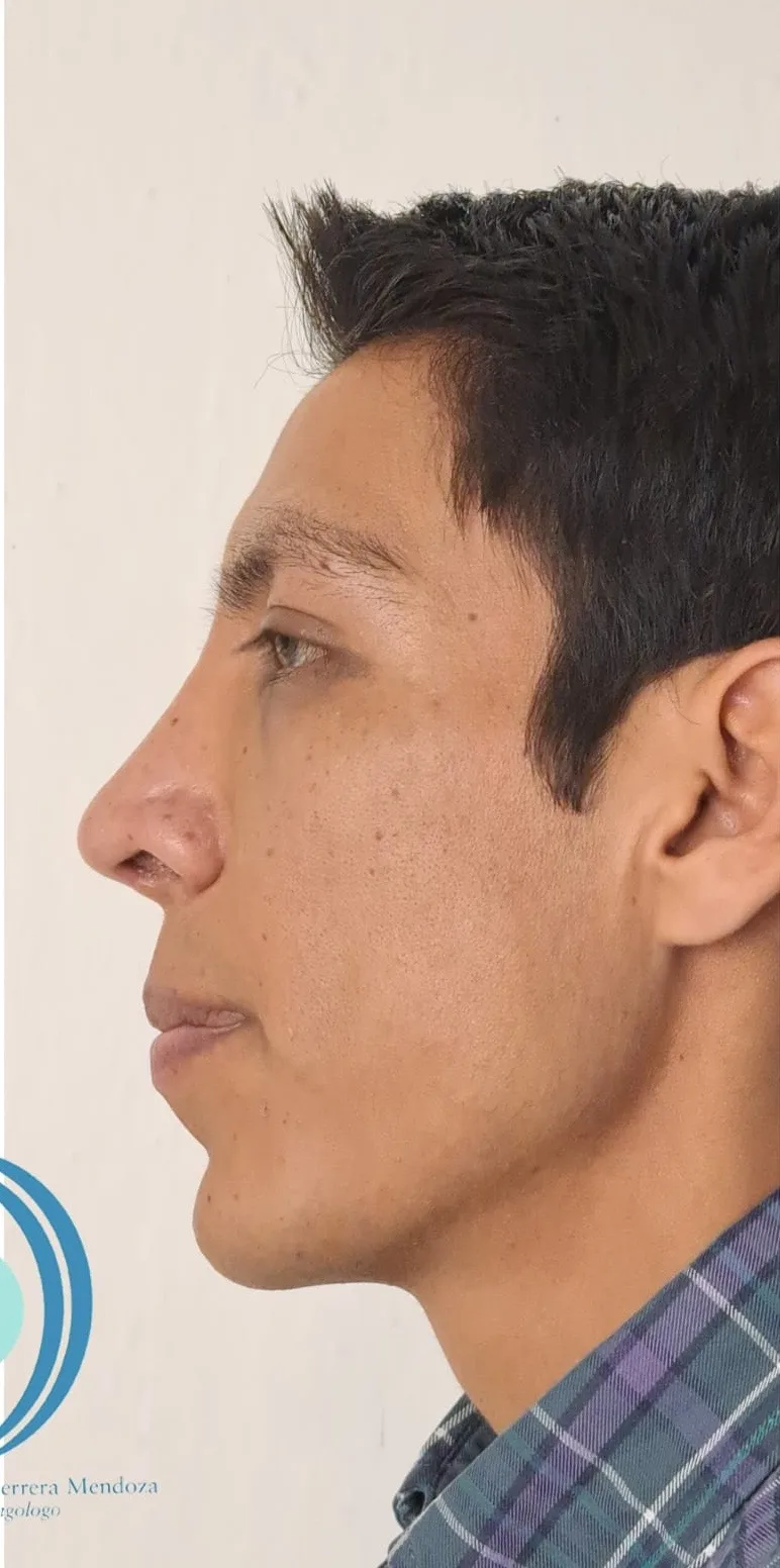 Antes de la Cirugía